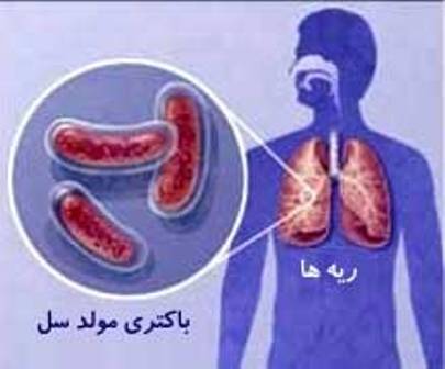 بيماري سل را بيشتر بشناسيم