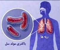 بيماري سل را بيشتر بشناسيم