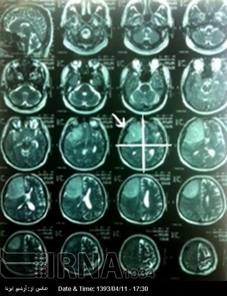 Iranian surgeon removes giant tumor Iranian surgeon removes giant tumor