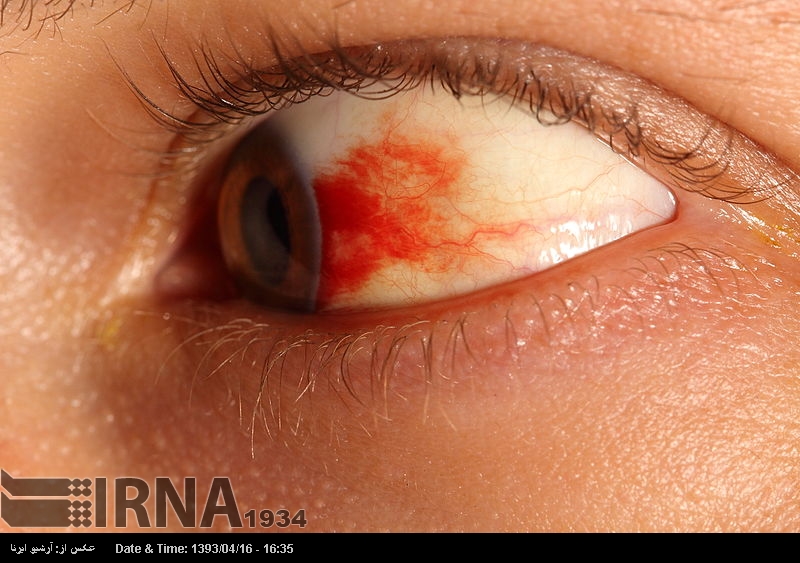Proper treatment of red eyes crucial Proper treatment of red eyes crucial
