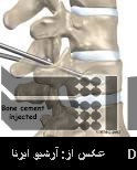 Iran increases bone cement strength Iran increases bone cement strength