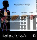 Fatty liver a major threat : Iran Daily Fatty liver a major threat : Iran Daily