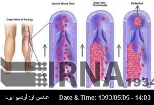 Device to prevent DVT made in Iran Device to prevent DVT made in Iran