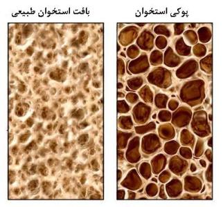 راهكارهای ساده برای پیشگیری از پوكی استخوان