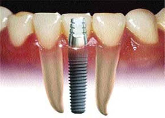 95 درصد موفقيت باز سازي استخوان دندان با ايمپلنت