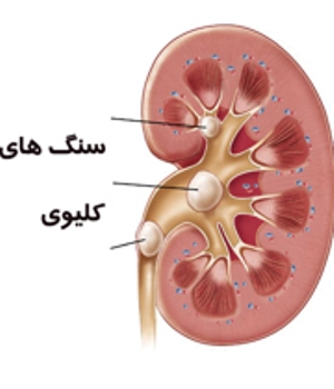 مردان 2.5 برابر بیشتر از زنان به  بیماری سنگ كلیه مبتلا می شوند