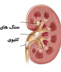 مردان 2.5 برابر بیشتر از زنان به  بیماری سنگ كلیه مبتلا می شوند