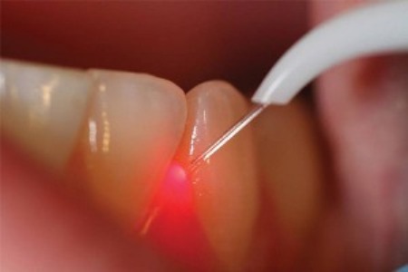 دستاورد محققان ایرانی در كاهش درد و خونریزی دندان با كمك لیزر