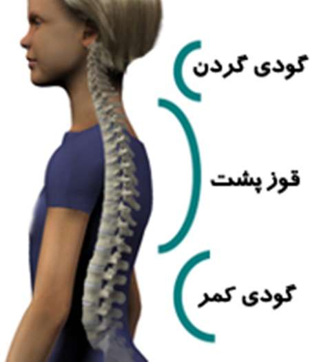 ناهنجاري اسكلتي در 60درصد دانش آموزان خراسان شمالي