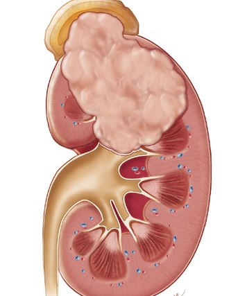 موفقیت آزمایش داروی های جدید سرطان كلیه