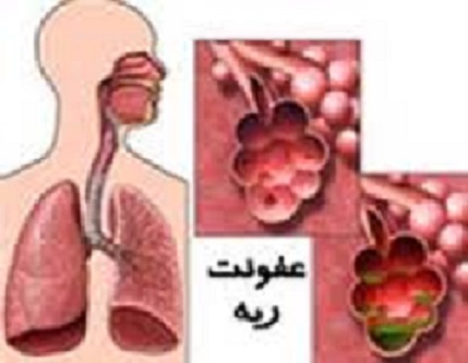 10 درصد ساكنان خراسان رضوي به بيماريهاي ريوي مبتلا هستند