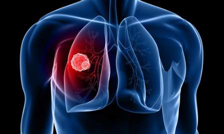 مولكولی كه از متاستاز سرطان ریه و سینه جلوگیری می كند