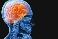 سكته مغزی از قابل درمان ترین بیماری های بشر است