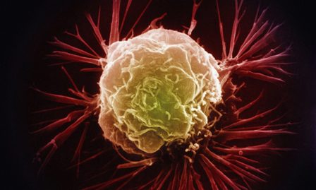حذف قند از سطح سلول هاي تومور، جديدترين شيوه درمان سرطان
