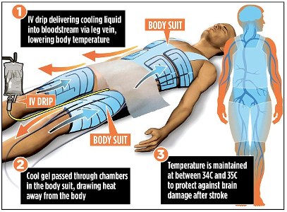 لباس خنك كننده بدن، راهكاري براي دفع آسيب هاي مغزي سكته