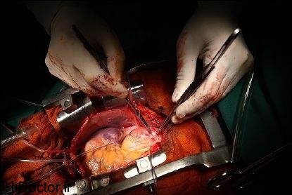 نخستين عمل قلب باز در بيمارستان امام سجاد (ع) ياسوج انجام شد
