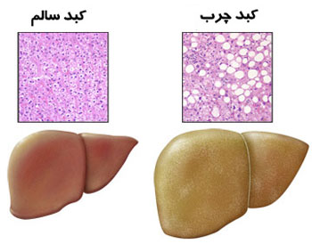 چاقی  علت اصلی كبد چرب