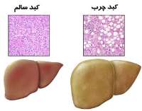 چاقی  علت اصلی كبد چرب