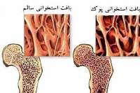 راه‌هاي پيشگيري از پوكي استخوان