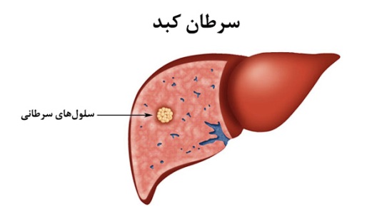 داروی جدیدی برای درمان شایع ترین نوع سرطان كبد تصویب شد