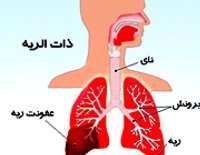 عفونت ريه هر 20 ثانيه جان يك نفر در دنيا را مي گيرد