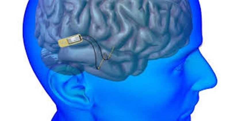 L'Iran, dans le top 25 pays dans le domaine des implants cérébraux L'Iran, dans le top 25 pays dans le domaine des implants cérébraux