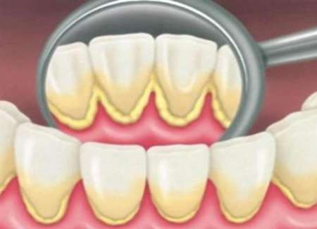 45 درصد جرم دندان ها را ميكروب تشكيل مي دهد