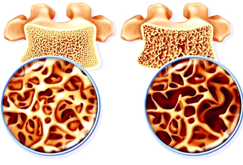 حدود 30 درصد جمعیت ایران به پوكی استخوان مبتلا هستند