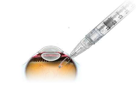 جلوگیری از نابینایی با استفاده از ایمپلنت چشمی