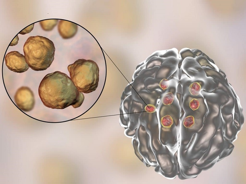 عفونت قارچي در مغز منجر به اختلال حافظه مي شود