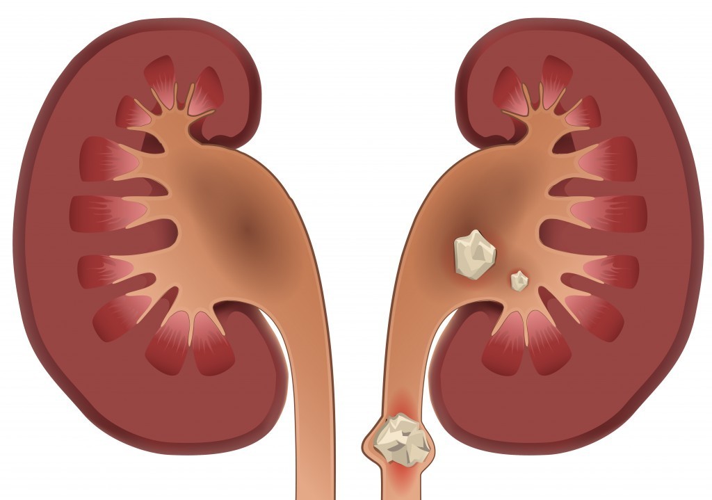 افزایش سالانه 100 هزارنفری بیماران مبتلا به كلیه سنگ ساز