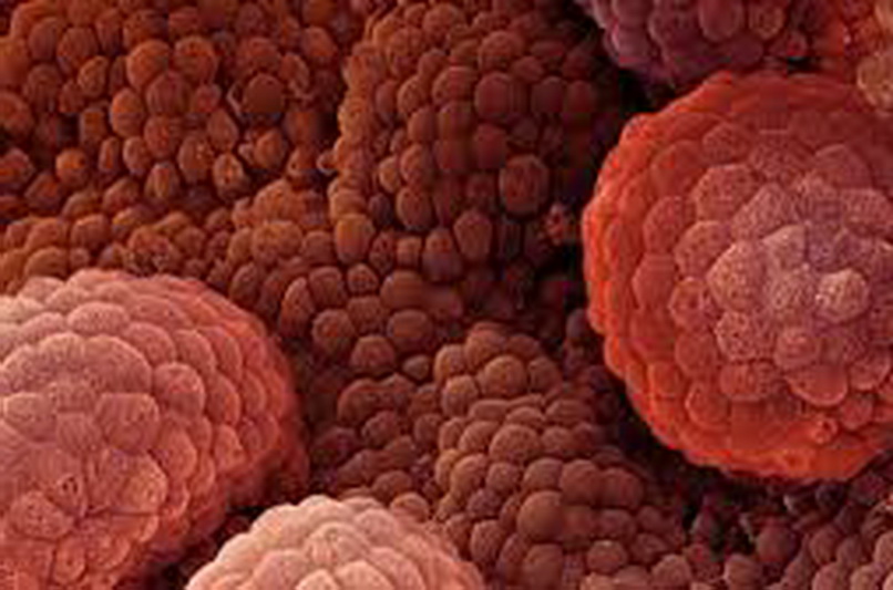 سرطان پروستات شايع ترين بيماري در مردان است